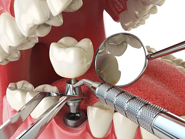 Best Emergency Root Canal Treatment in Chewelah, WA